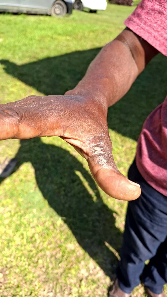 Michael’s hand shows the lingering effects of chemical overexposure, even after the worst of the flare-up has subsided.