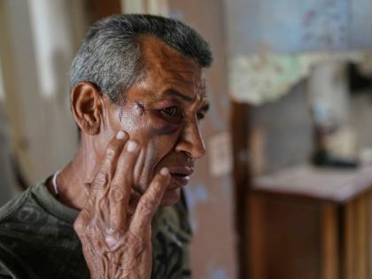 Wilman Gonzalez shows an injury he says he suffered when his home was hit during US military operations to capture Venezuelan President Nicolas Maduro in Catia La Mar, Venezuela.